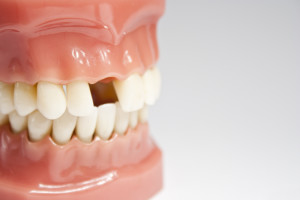 Why You Should Replace Your Missing Teeth